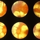 Yellow White Subretinal Exudates